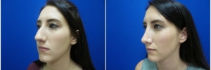 rhinoplasty-7-1