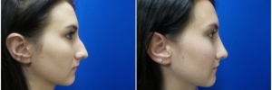 rhinoplasty-7-2