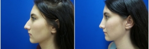 rhinoplasty-7-3