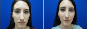 rhinoplasty-7-4
