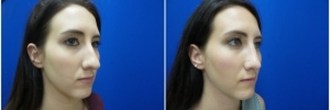rhinoplasty-7-5