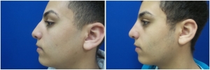 rhinoplasty-before-after-photo-11-1