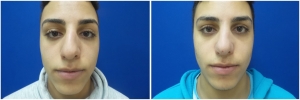 rhinoplasty-before-after-photo-11-2
