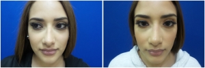 rhinoplasty-before-after-photo-13-1