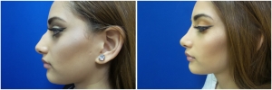 rhinoplasty-before-after-photo-13-2