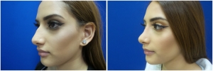 rhinoplasty-before-after-photo-13-3
