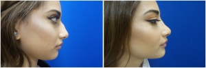 rhinoplasty-before-after-photo-13-4
