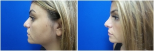 rhinoplasty-before-after-photo-4-1