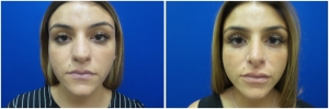 rhinoplasty-before-after-photo-4-2