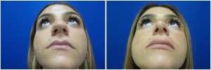 rhinoplasty-before-after-photo-4-3