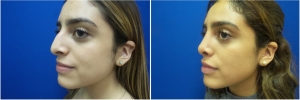 rhinoplasty-before-after-photo-5-1