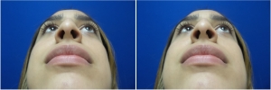 rhinoplasty-before-after-photo-5-2