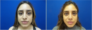 rhinoplasty-before-after-photo-5-3