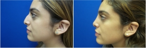 rhinoplasty-before-after-photo-5-4