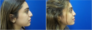 rhinoplasty-before-after-photo-5-5