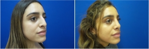 rhinoplasty-before-after-photo-5-6