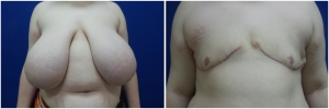 top-surgery-female-to-male-2-1