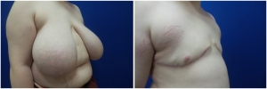 top-surgery-female-to-male-2-2