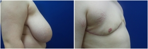 top-surgery-female-to-male-2-3
