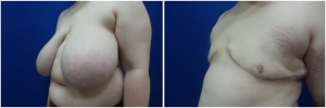 top-surgery-female-to-male-2-4