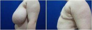 top-surgery-female-to-male-2-5