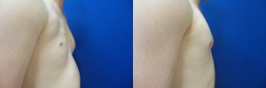 top-surgery-female-to-male-3-1