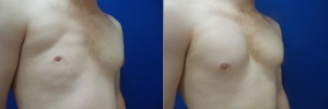 top-surgery-female-to-male-3-2