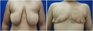 top-surgery-female-to-male-4-1