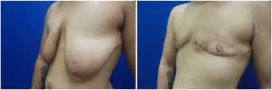 top-surgery-female-to-male-4-2