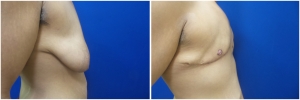top-surgery-female-to-male-4-3