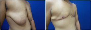 top-surgery-female-to-male-4-4