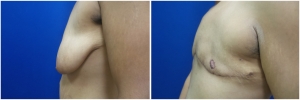 top-surgery-female-to-male-4-5