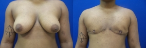 top-surgery-female-to-male-5-1