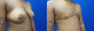 top-surgery-female-to-male-5-2