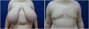 top-surgery-female-to-male-6-1