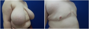 top-surgery-female-to-male-6-2