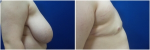 top-surgery-female-to-male-6-3