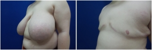 top-surgery-female-to-male-6-4