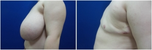 top-surgery-female-to-male-6-5