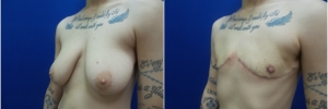 top-surgery-female-to-male1-1