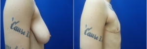 top-surgery-female-to-male1-2