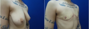 top-surgery-female-to-male1-3