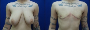 top-surgery-female-to-male1-4