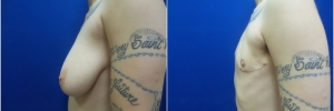 top-surgery-female-to-male1-5
