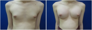 top-surgery-male-to-female-before-after-1-1