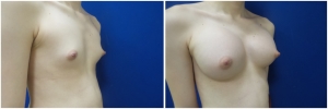 top-surgery-male-to-female-before-after-1-2