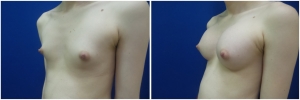top-surgery-male-to-female-before-after-1-3