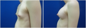 top-surgery-male-to-female-before-after-1-4