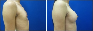 top-surgery-male-to-female-before-after-2-1