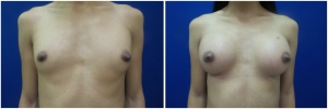 top-surgery-male-to-female-before-after-2-2